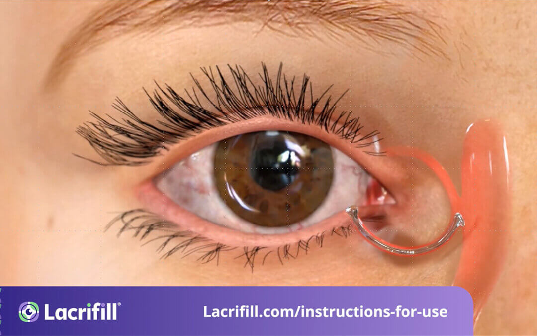 How Does Lacrifill Aid in Tear Conservation?